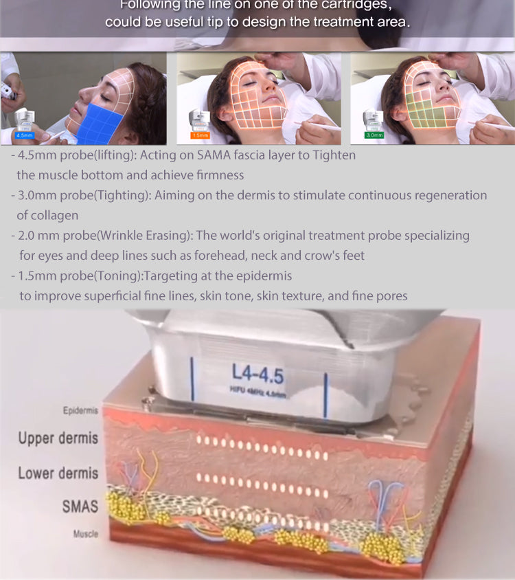 7D HIFU for Face and Body Contouring