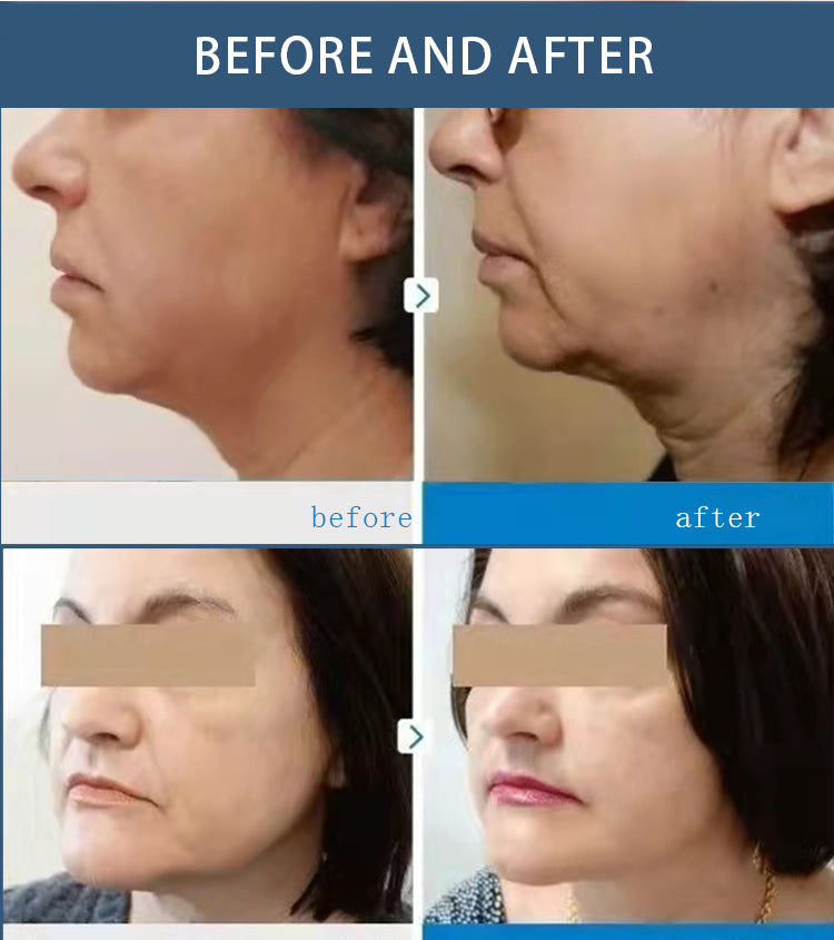 7D HIFU for Face and Body Contouring